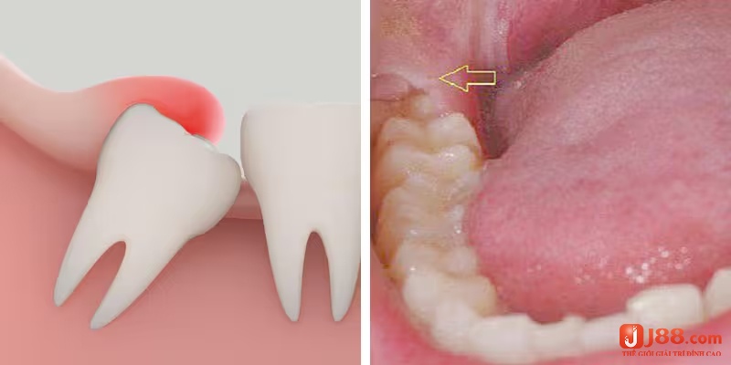 Nằm mơ thấy mọc răng khôn cho thấy vận may đang đến